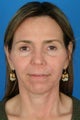 Female patient who wanted nonsurgical rejuvenation.