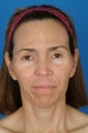 Female patient who wanted nonsurgical rejuvenation.