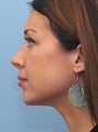 Non-Surgical Chin Augmentation Using Radiesse