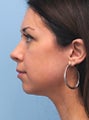 Non-Surgical Chin Augmentation Using Radiesse
