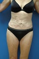 revision of liposuction