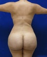 29 y.o. female – Liposuction of abdomen, flanks, and back with fat transfer to buttocks & hips – 1400 cc per side