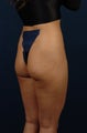20 Year Old Female - Gluteal Augmentation