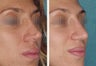 Female Revision Rhinoplasty
