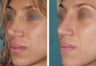 Female Revision Rhinoplasty