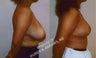 28 Year-Old Female Treated for Breast Hypertrophy