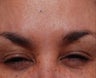Female Treated for Forehead Wrinkles