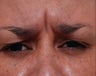 Female Treated for Forehead Wrinkles