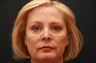 57 Year old Female - Botox and Filler Injections