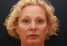 57 Year old Female - Botox and Filler Injections