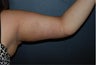 Arm Lift (brachioplasty) with liposuction