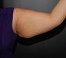 Arm Lift (brachioplasty) with liposuction