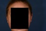 26 Year Old Bilateral Otoplasty
