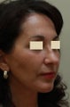 Facial Rejuvenation