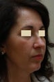 Facial Rejuvenation
