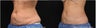 Middle Age Woman Treated for Non-Invasive Fat Removal with CoolSculpting