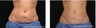 Middle Age Woman Treated for Non-Invasive Fat Removal with CoolSculpting