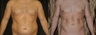 Abdomen Sculpting