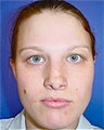 Septorhinoplasty
