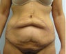 Post Weight Loss