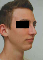 Chin Implant