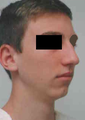 Chin Implant