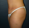 Butt Augmentation