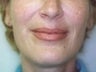 Female patient whose condition was corrected using radiesse