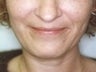 Female patient whose condition was corrected using radiesse
