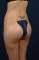22 Year Old Female - Gluteal Augmentation