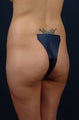 22 Year Old Female - Gluteal Augmentation