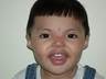 Hypertelorism / Craniofacial