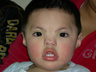 Hypertelorism / Craniofacial