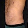 Liposuction