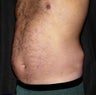 Liposuction