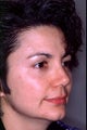 Revision rhinoplasty