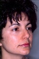 Revision rhinoplasty