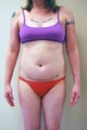 36 year old female liposuction of the upper and lower abdomen and flanks
