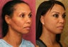 African Americn Rhinoplasty