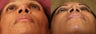 African Americn Rhinoplasty