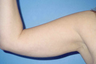 Arm Liposuction