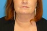 49 Year Old Female Underwent Neck Lift