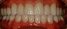 Full Mouth Rehabilitation