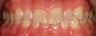 Full Mouth Rehabilitation