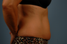 truSculpt- one treatment to abdomen