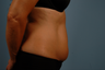 truSculpt- one treatment to abdomen