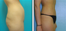 Liposuction Before & After