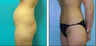 Liposuction Before & After