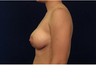 Breast Augmentation