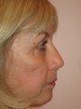 Upper and lower lid blepharoplasty, chemical peel to lower lids